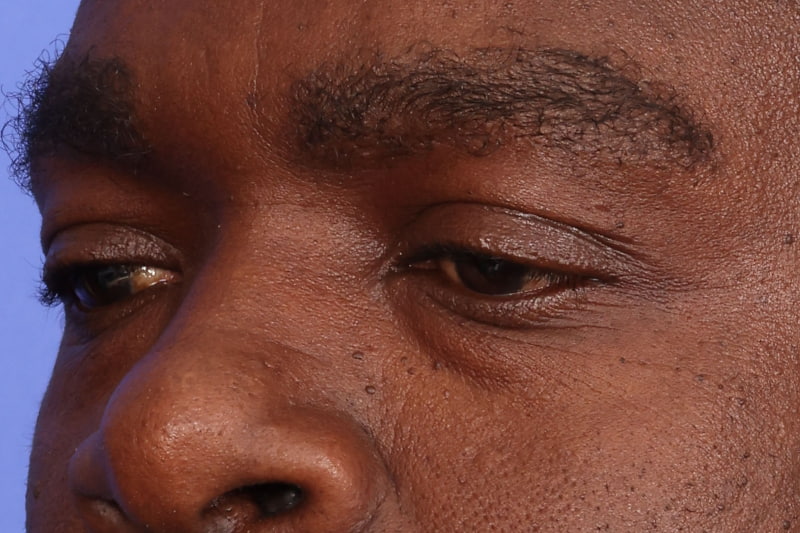 Eyelid Surgery Before & After Image