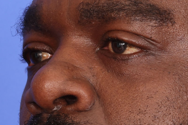 Eyelid Surgery Before & After Image