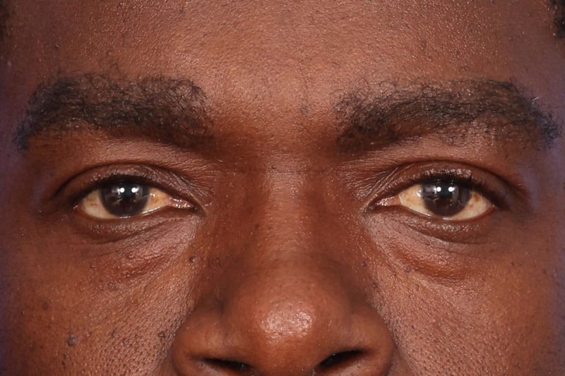 Eyelid Surgery Before & After Image