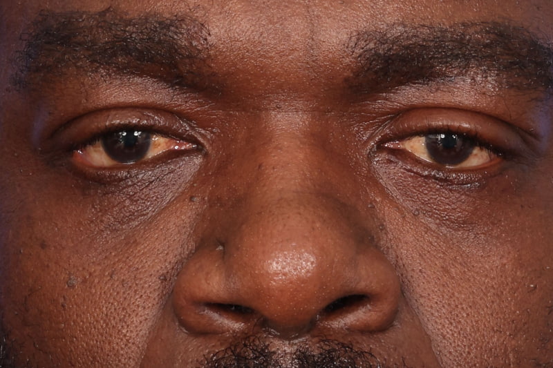 Eyelid Surgery Before & After Image