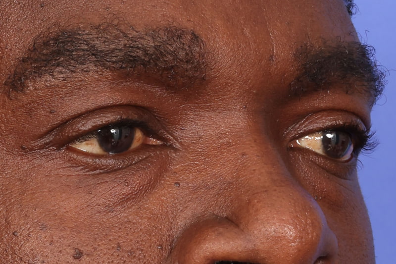 Eyelid Surgery Before & After Image