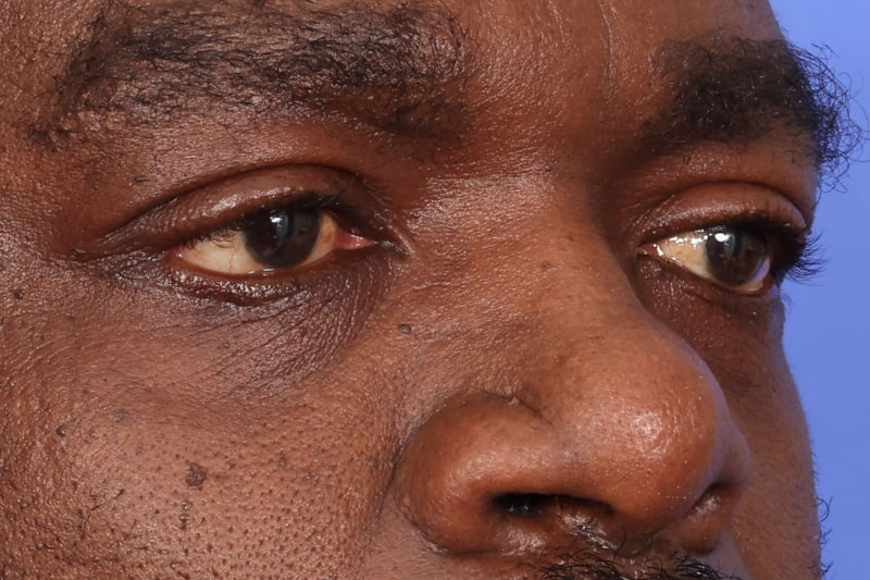 Eyelid Surgery Before & After Image