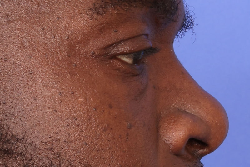Eyelid Surgery Before & After Image