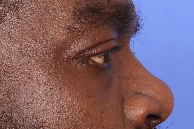 Eyelid Surgery Before & After Image