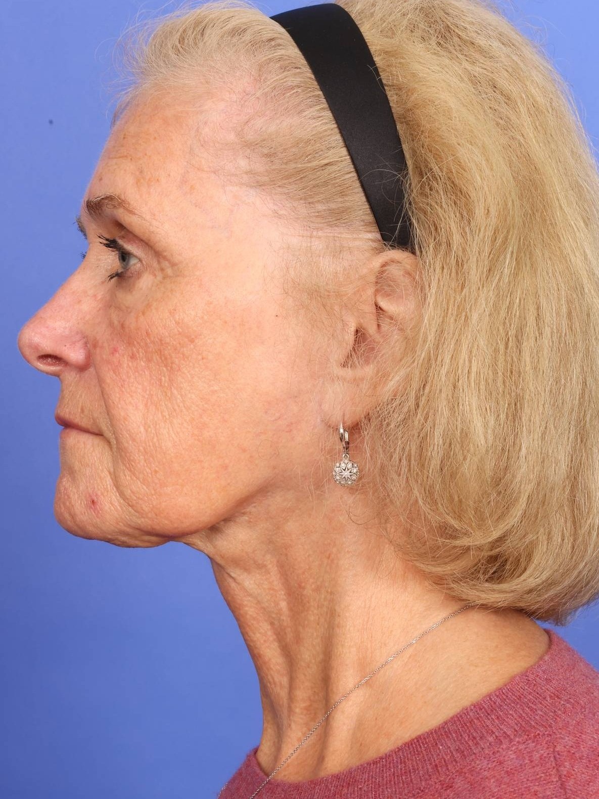 Face Lift Before & After Image