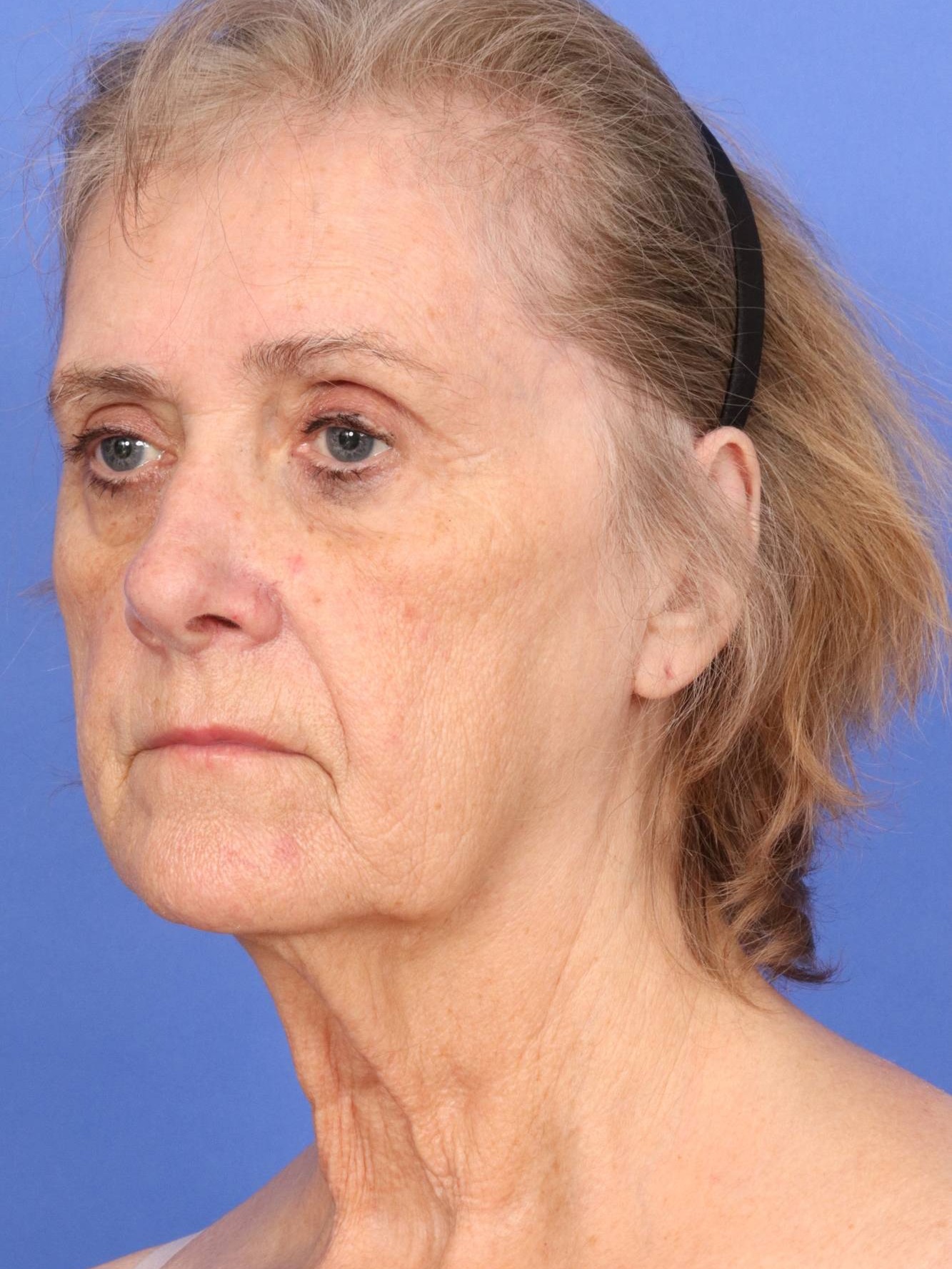 Face Lift Before & After Image