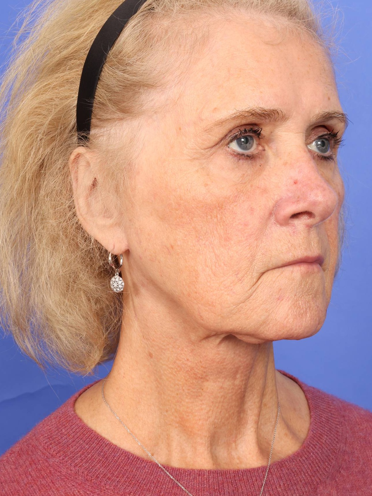 Face Lift Before & After Image