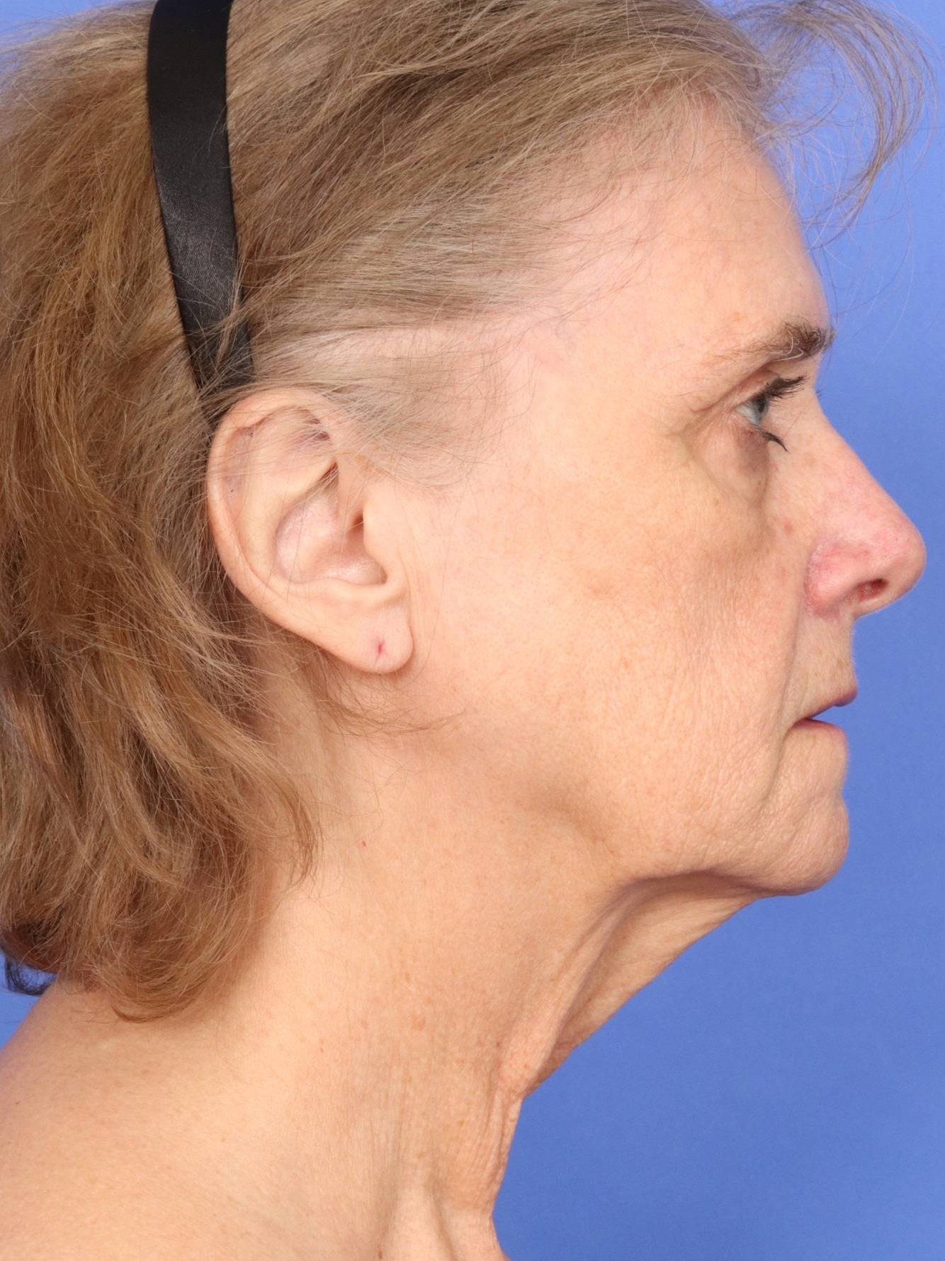 Face Lift Before & After Image