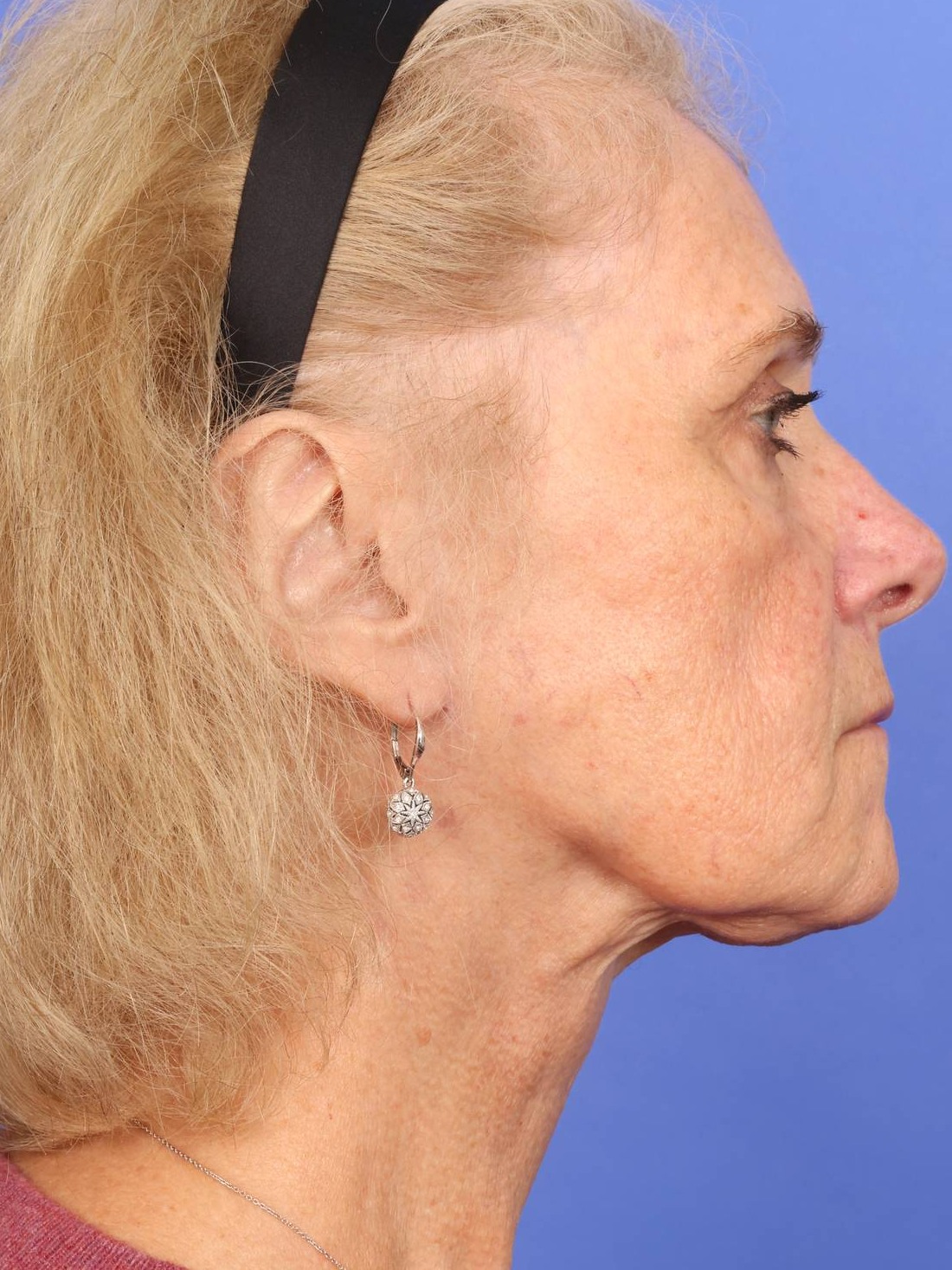 Face Lift Before & After Image