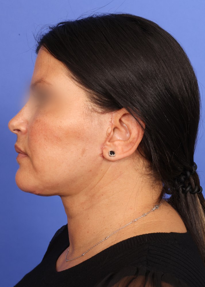 Face Lift Before & After Image