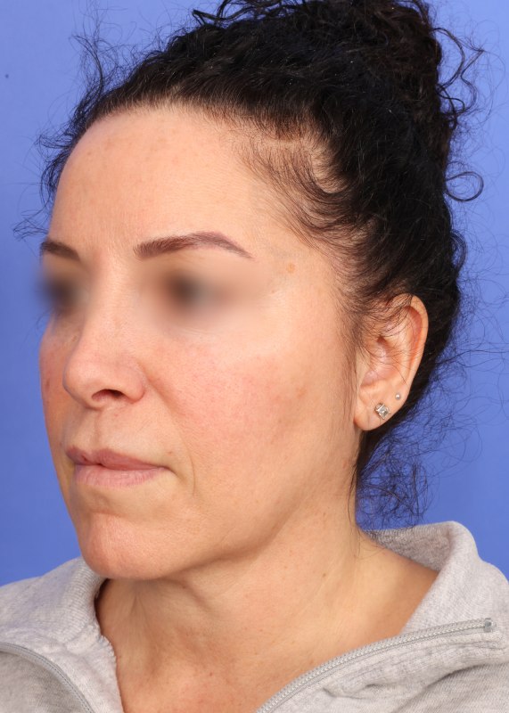 Face Lift Before & After Image