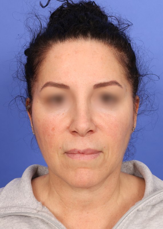 Face Lift Before & After Image