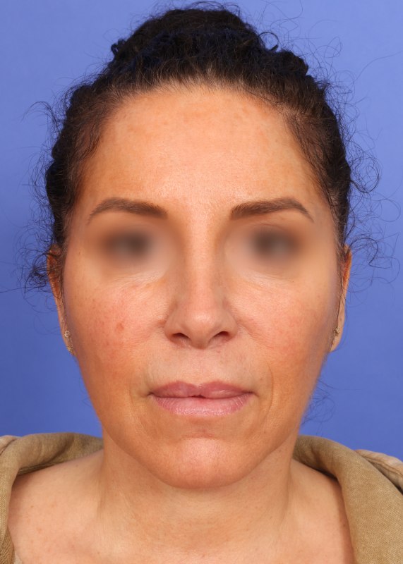 Face Lift Before & After Image