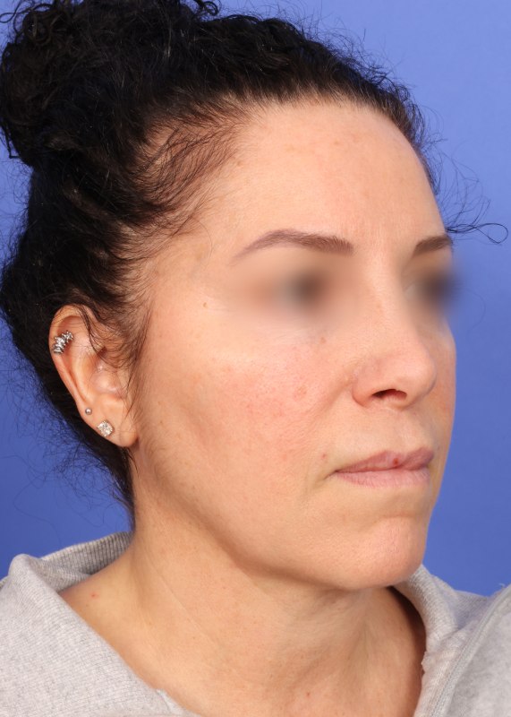 Face Lift Before & After Image