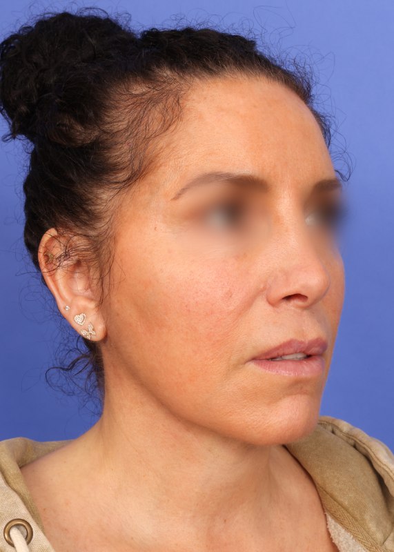 Face Lift Before & After Image