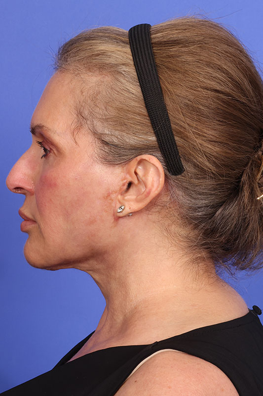 Face Lift Before & After Image