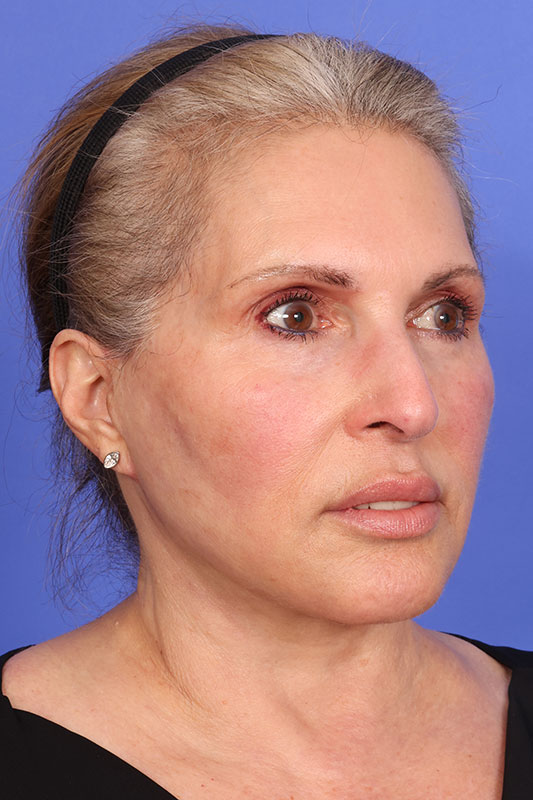 Face Lift Before & After Image