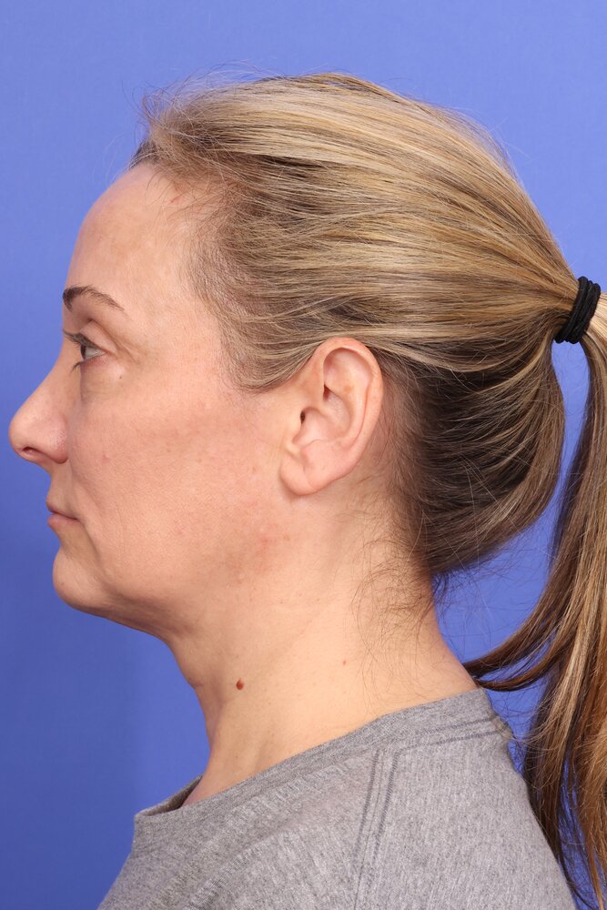 Face Lift Before & After Image
