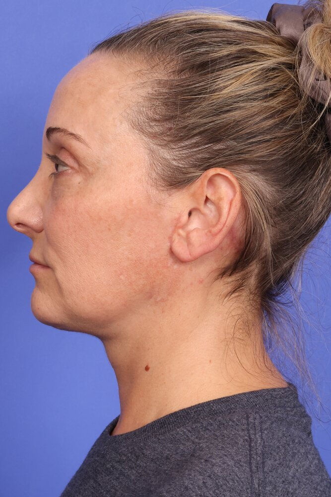 Face Lift Before & After Image