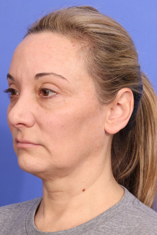 Face Lift Before & After Image
