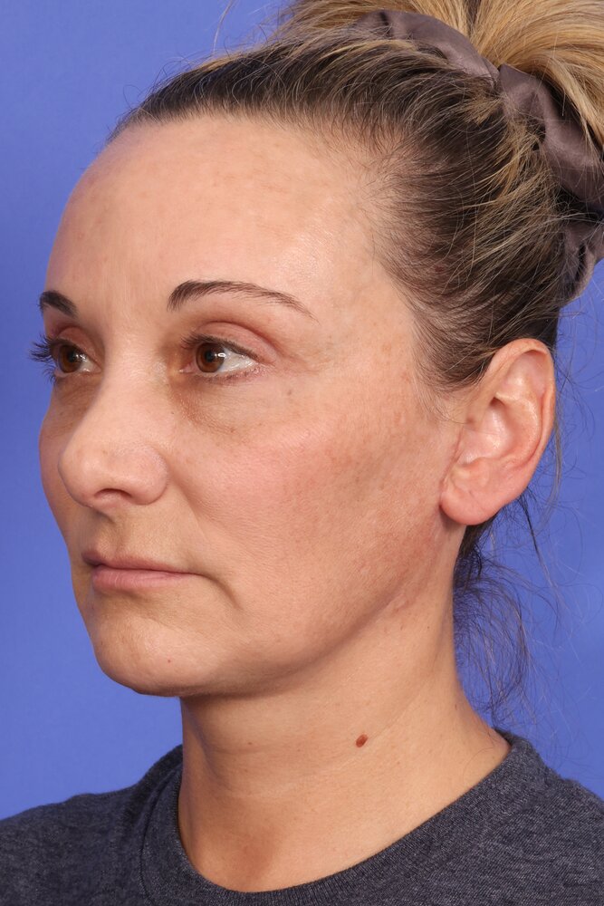 Face Lift Before & After Image
