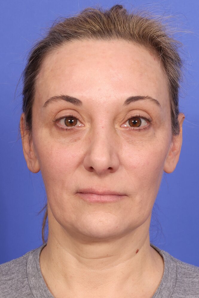 Face Lift Before & After Image