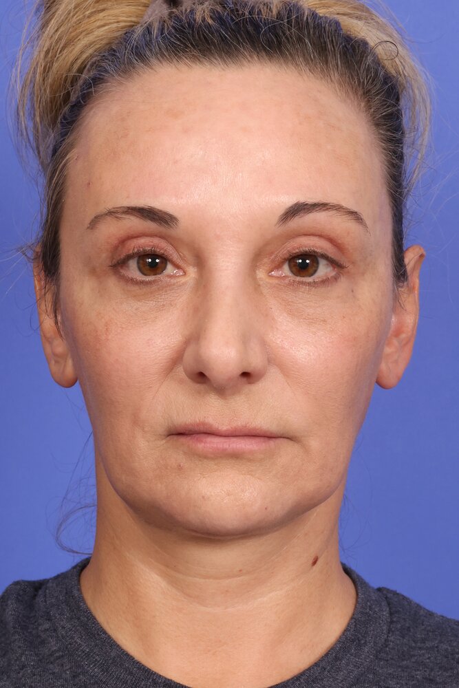 Face Lift Before & After Image