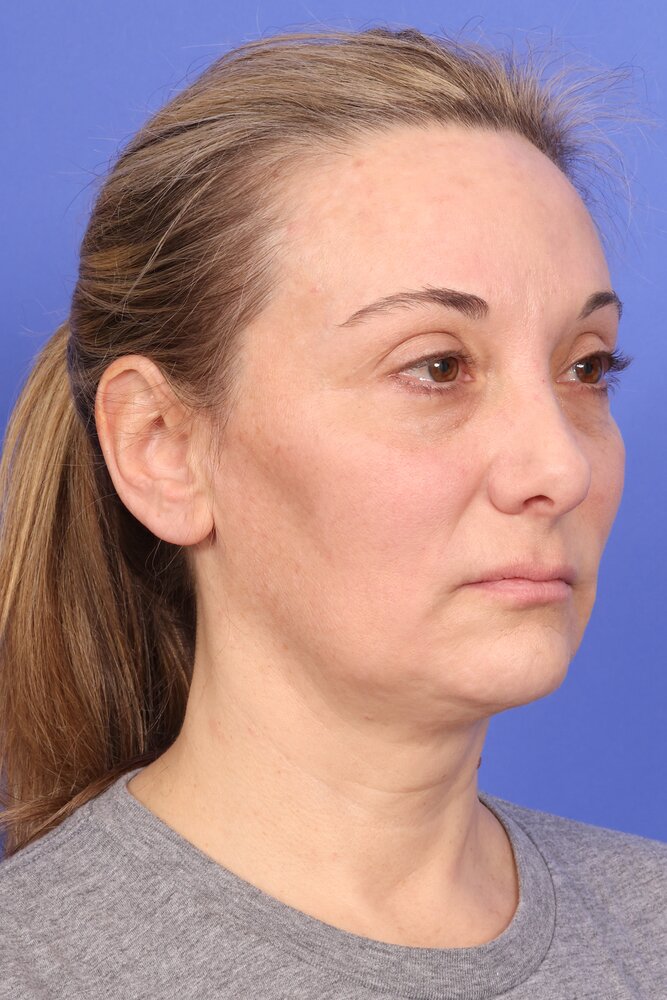 Face Lift Before & After Image