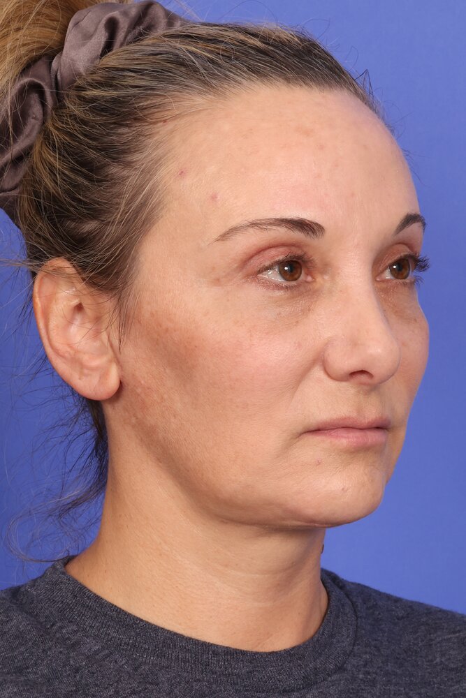 Face Lift Before & After Image