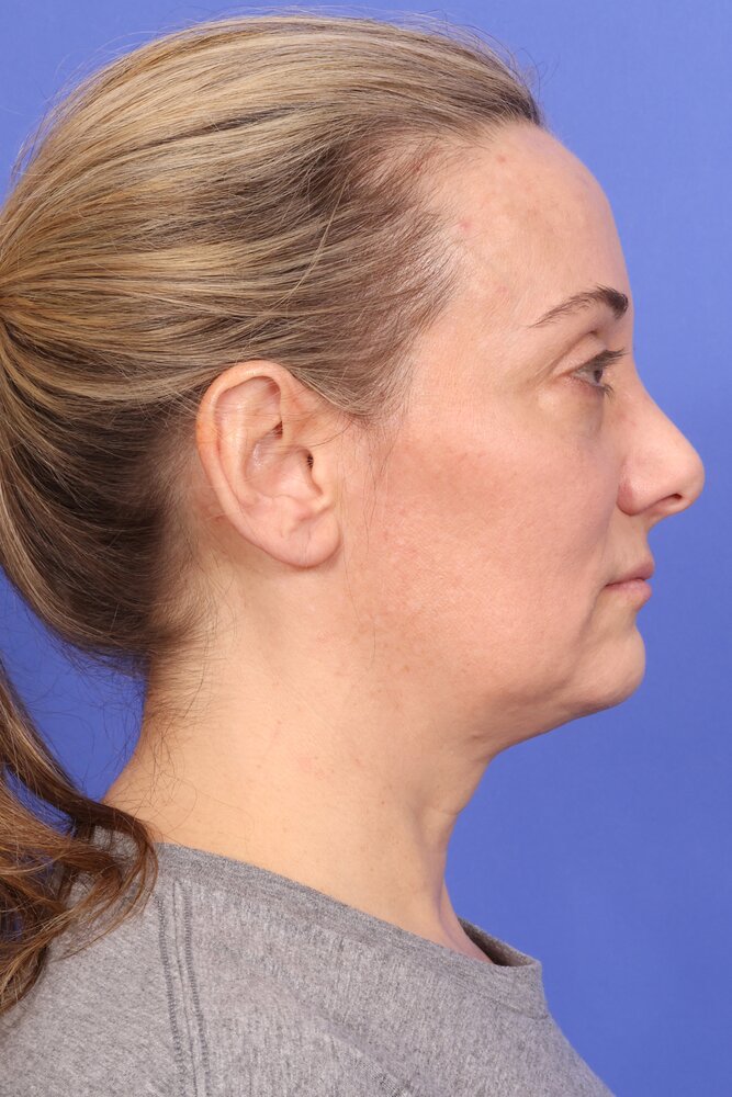 Face Lift Before & After Image
