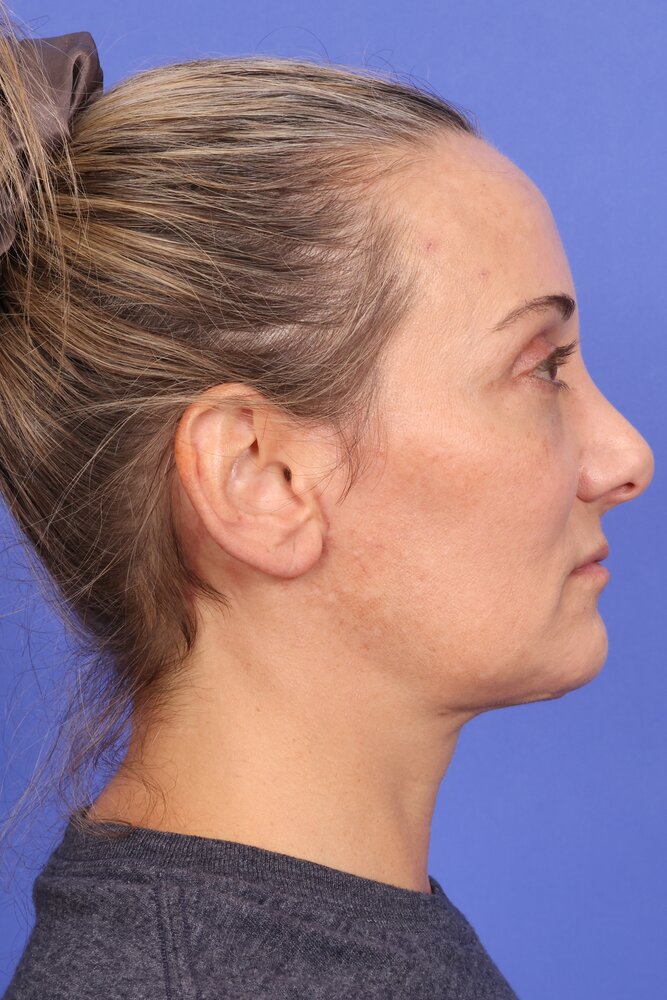 Face Lift Before & After Image