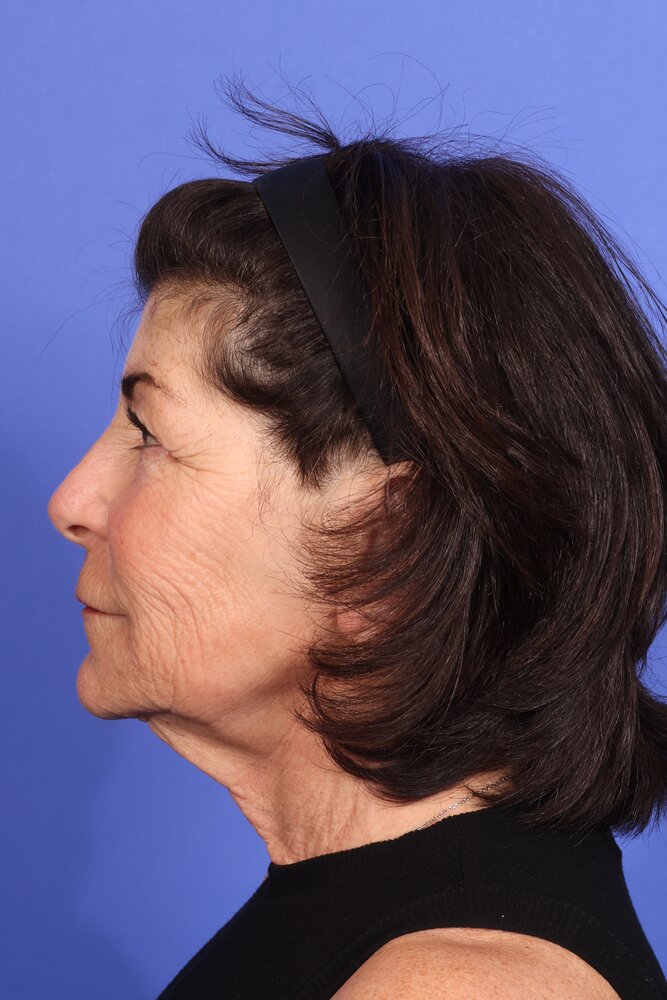 Face Lift Before & After Image
