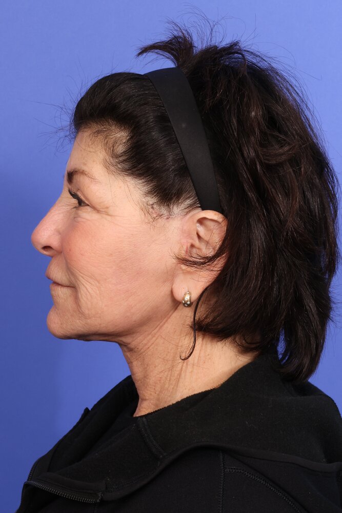 Face Lift Before & After Image