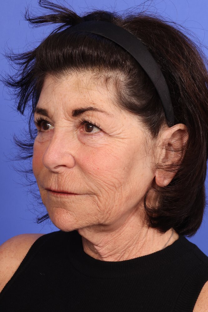 Face Lift Before & After Image