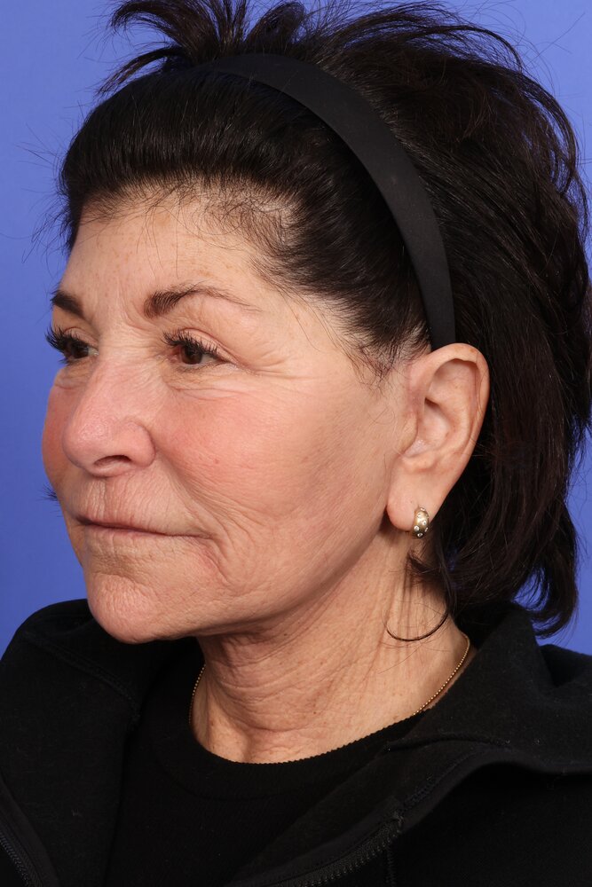 Face Lift Before & After Image