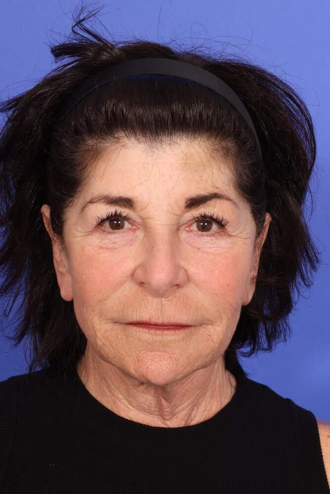 Face Lift Before & After Image