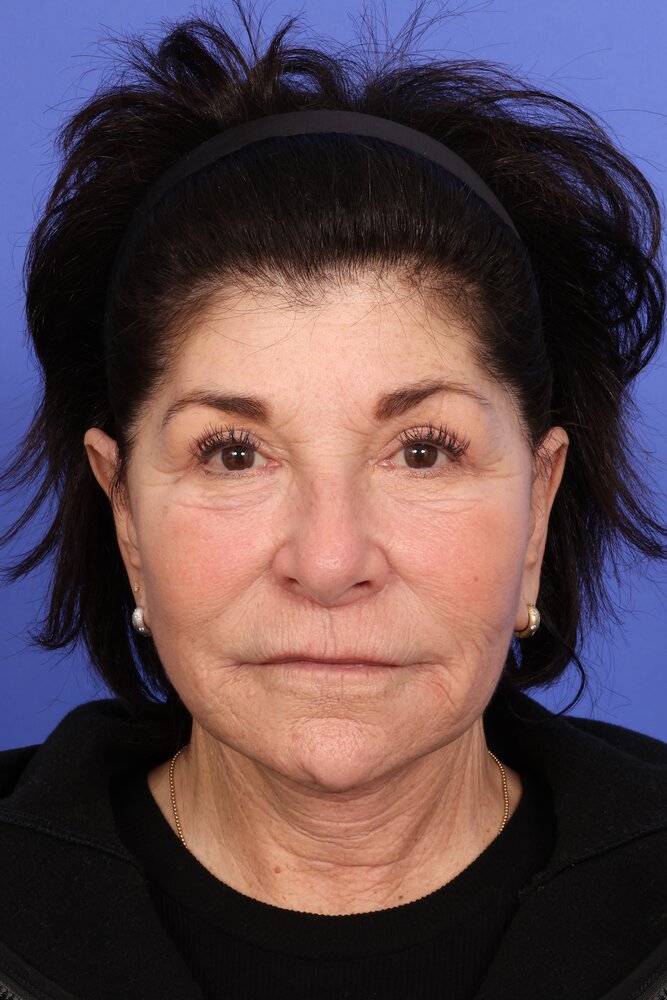 Face Lift Before & After Image