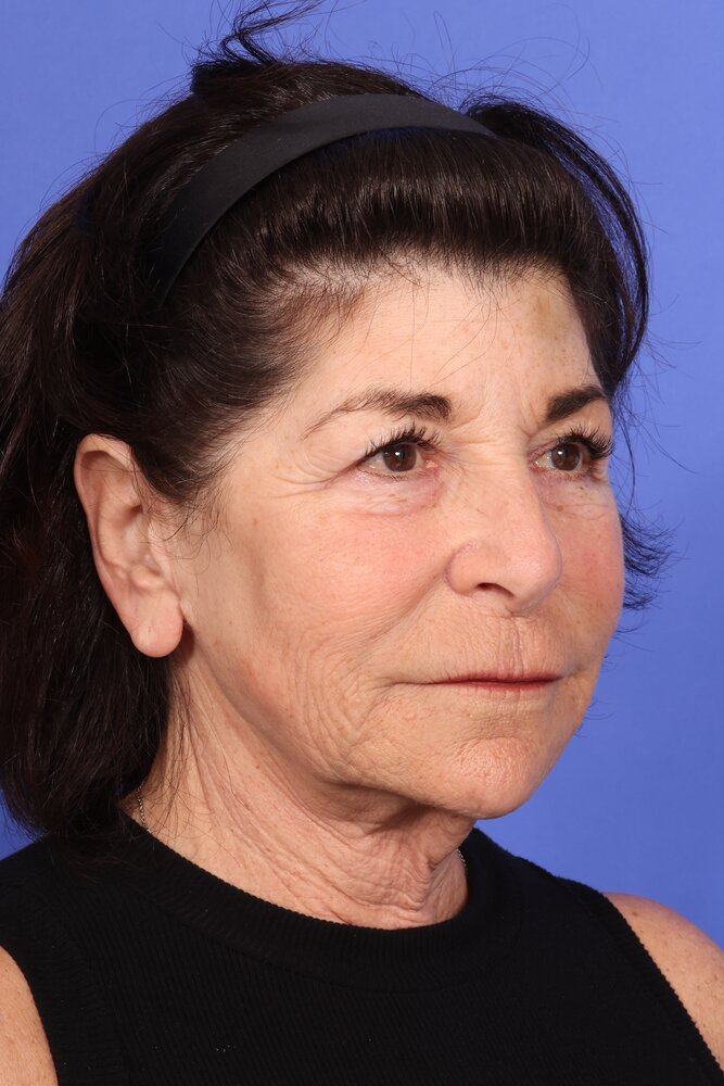 Face Lift Before & After Image
