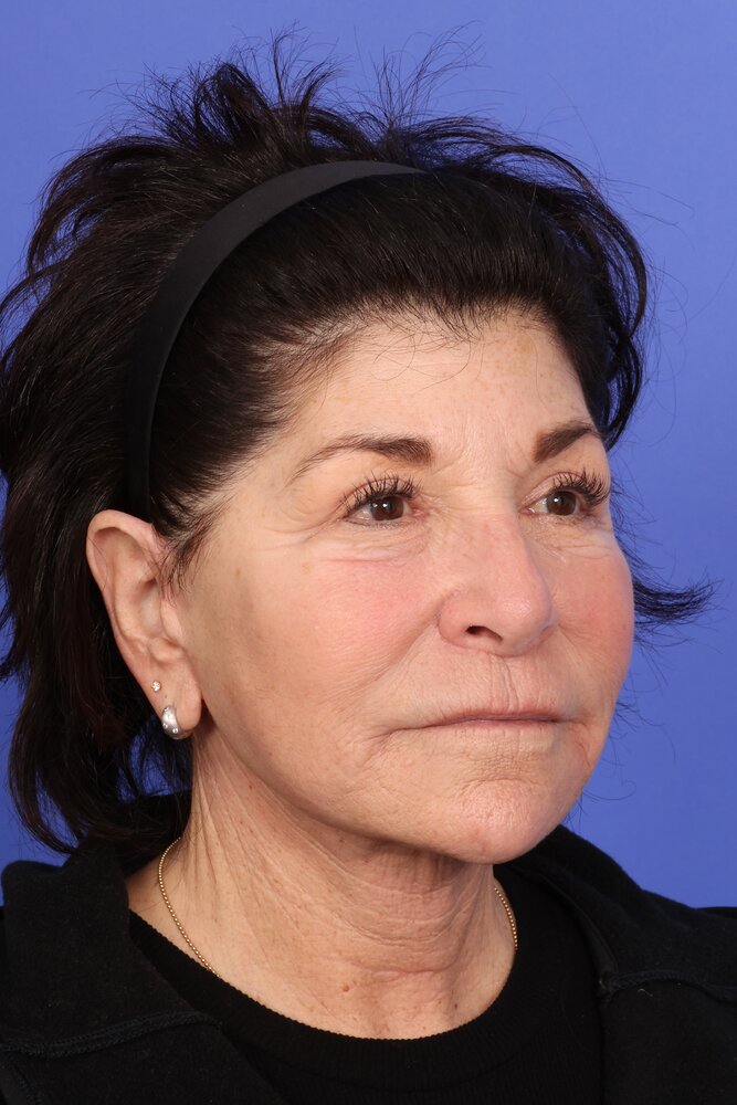 Face Lift Before & After Image