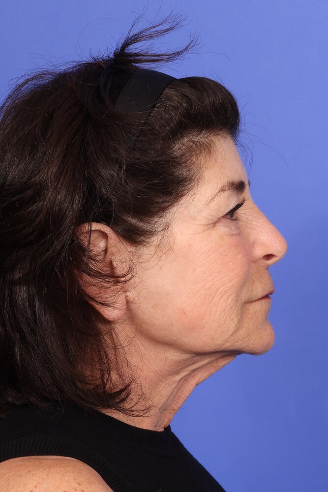 Face Lift Before & After Image