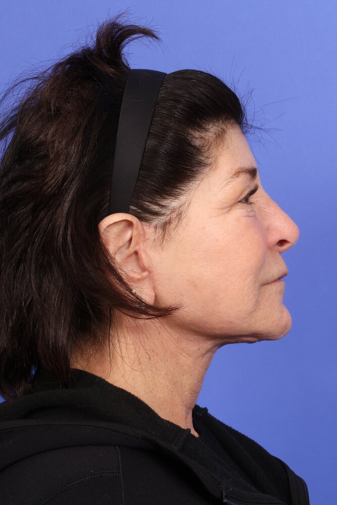Face Lift Before & After Image