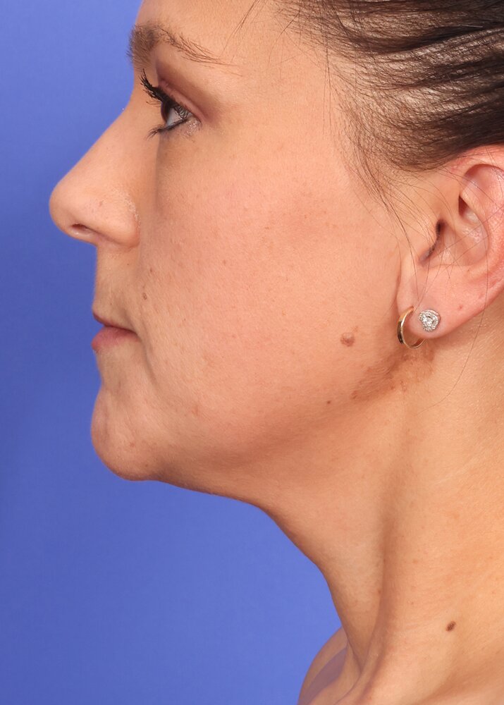 Face Lift Before & After Image