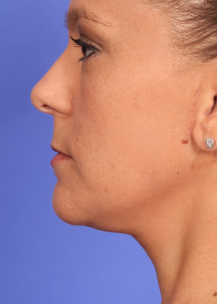 Face Lift Before & After Image