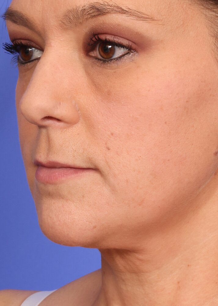 Face Lift Before & After Image