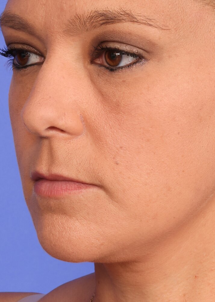 Face Lift Before & After Image