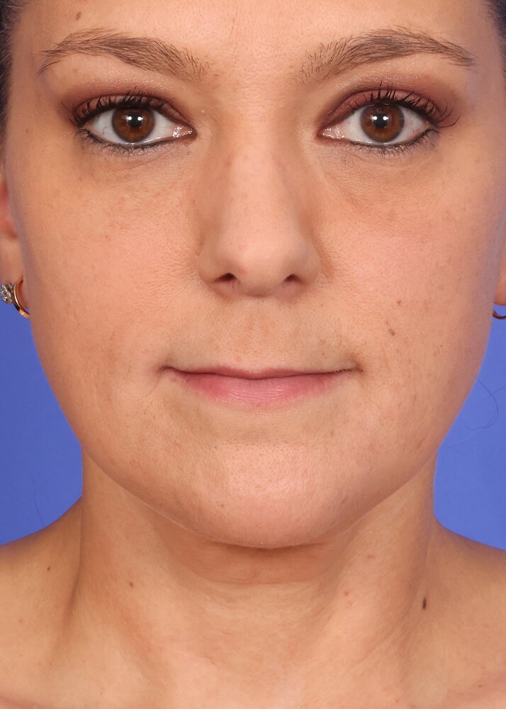 Face Lift Before & After Image