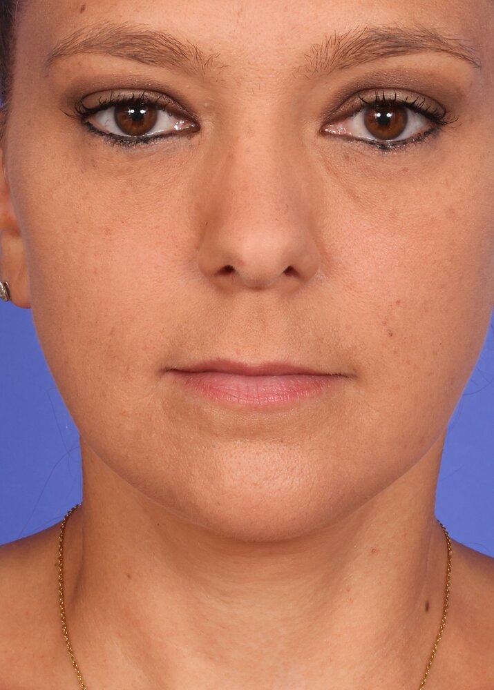 Face Lift Before & After Image