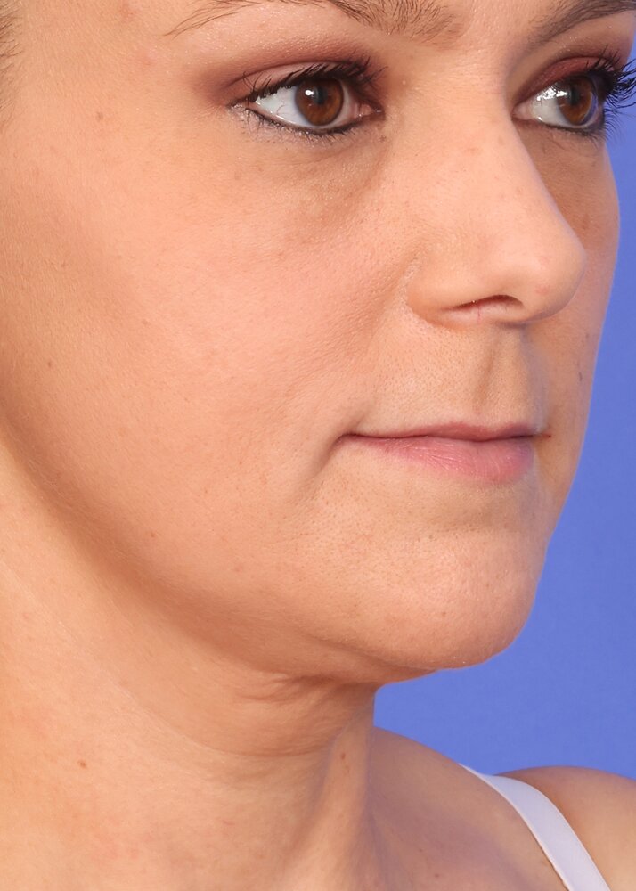 Face Lift Before & After Image