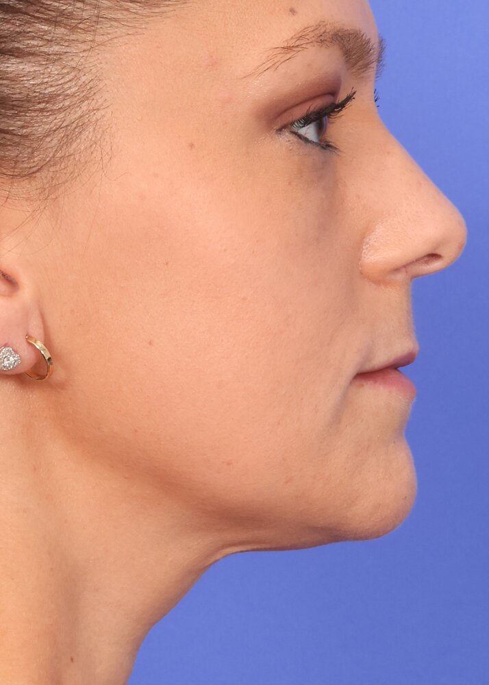Face Lift Before & After Image