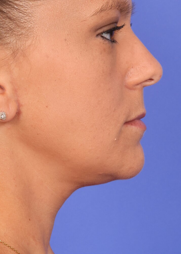 Face Lift Before & After Image
